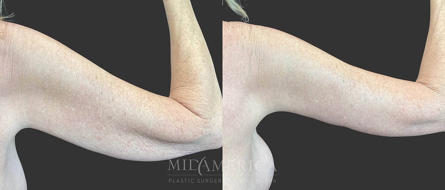 Brachioplasty Before & After