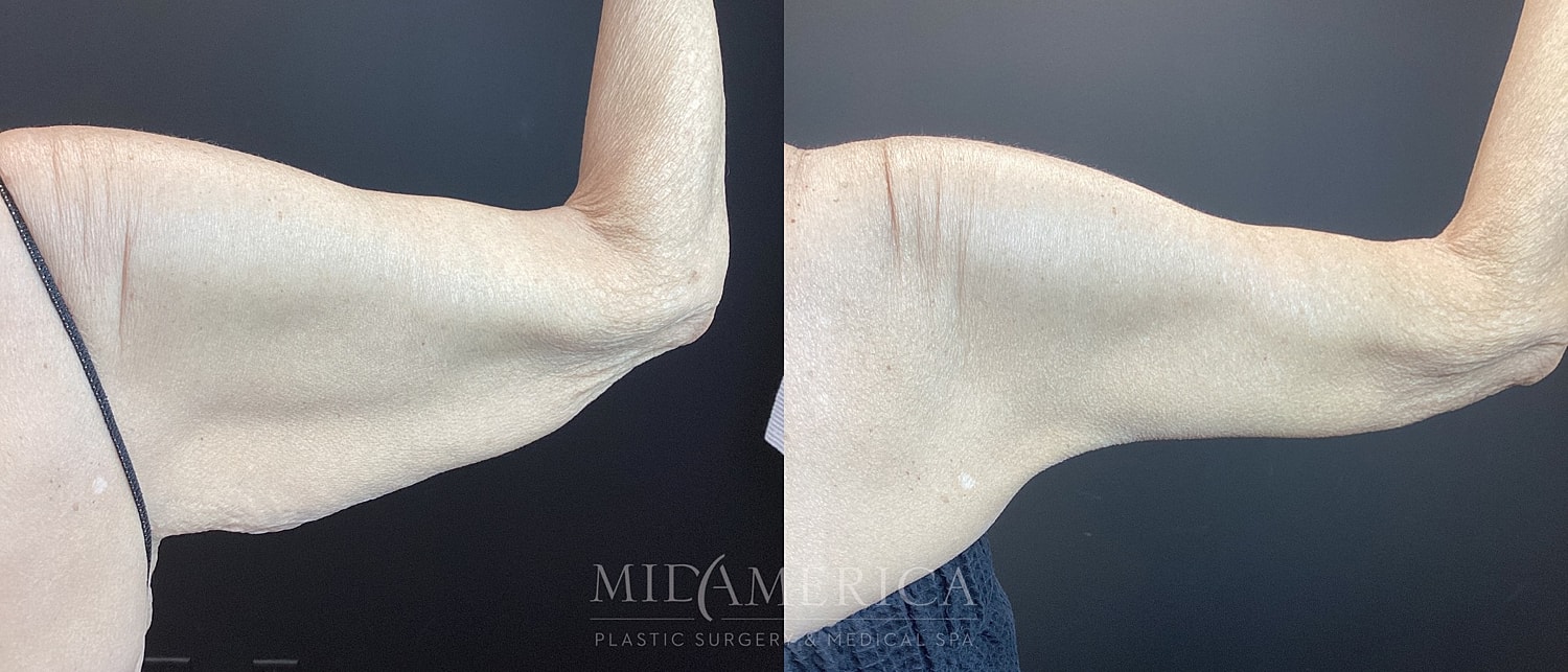 Brachioplasty Before & After
