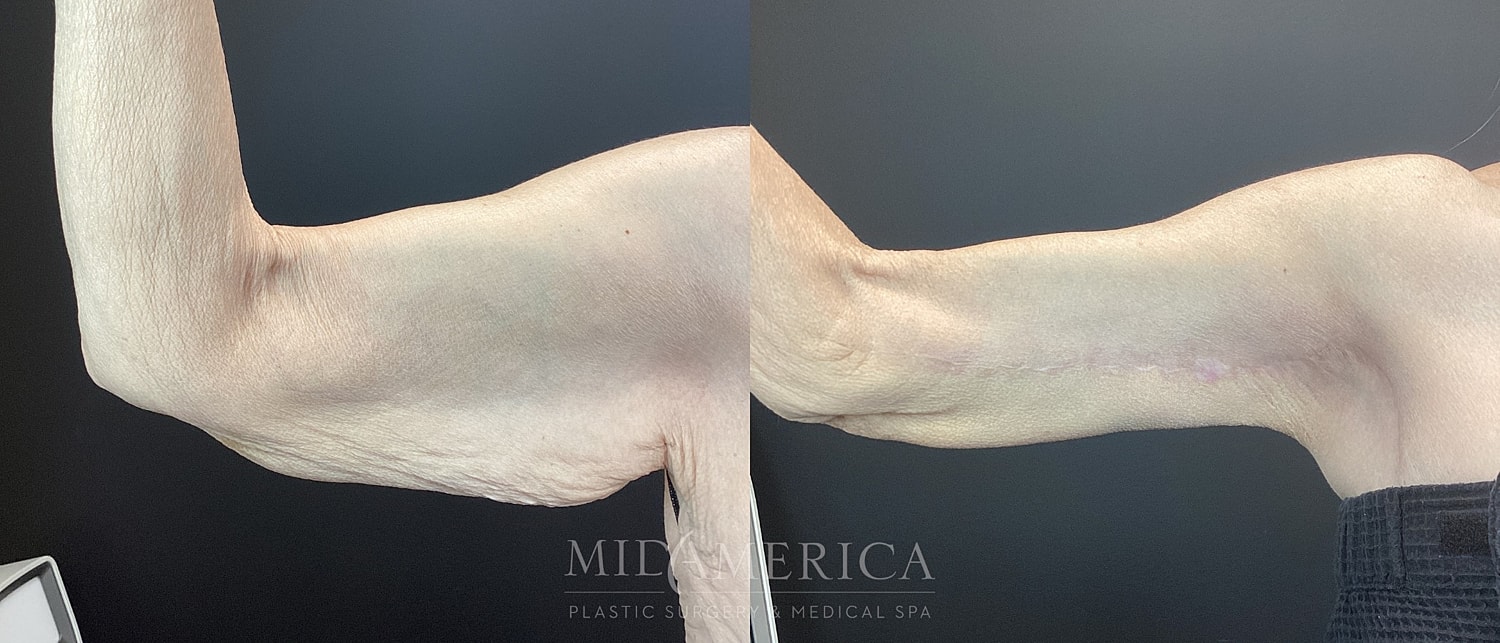 Brachioplasty Before & After