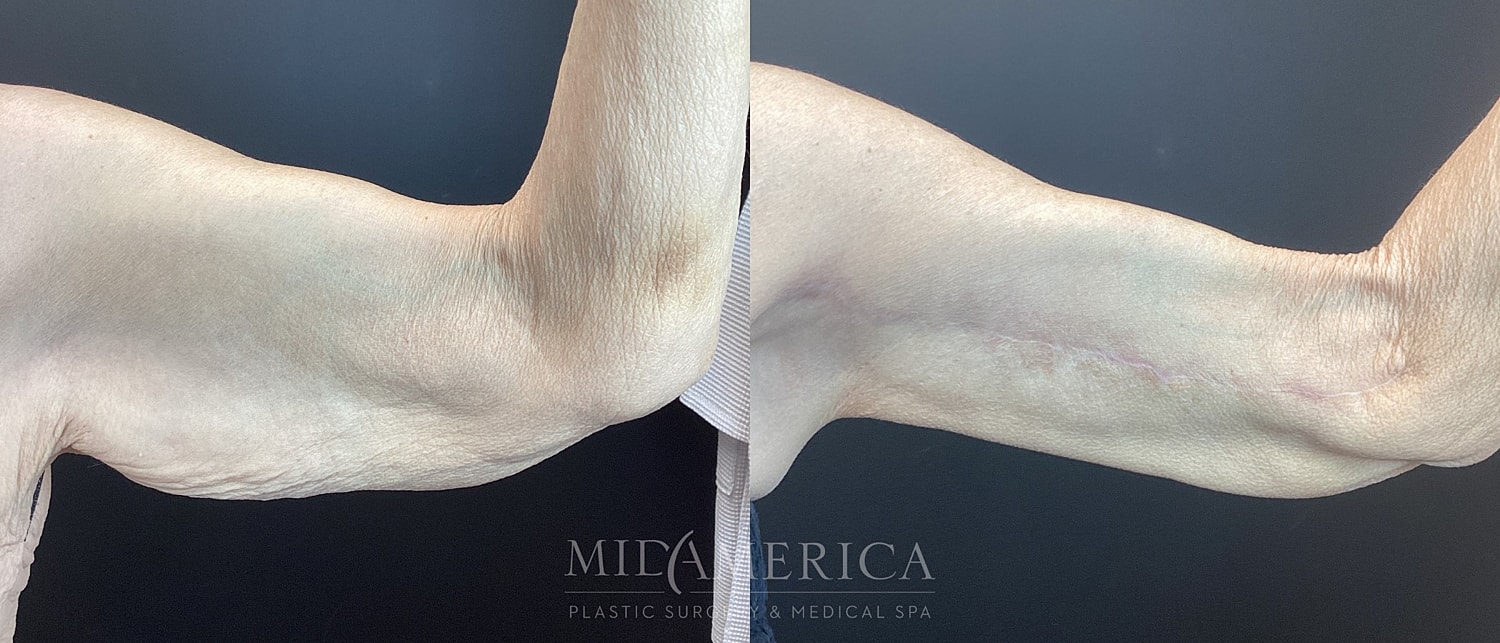 Brachioplasty Before & After