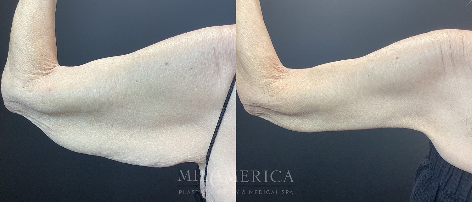 Brachioplasty Before & After