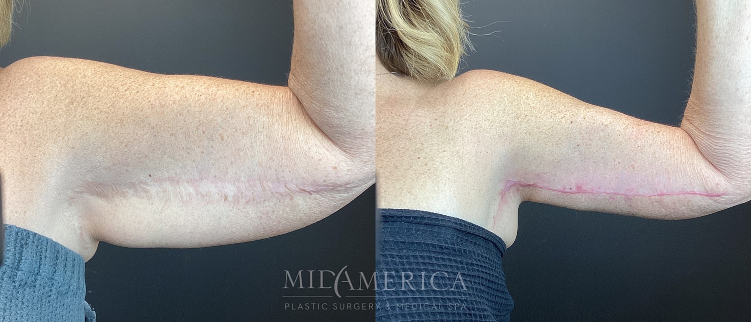Brachioplasty Before & After