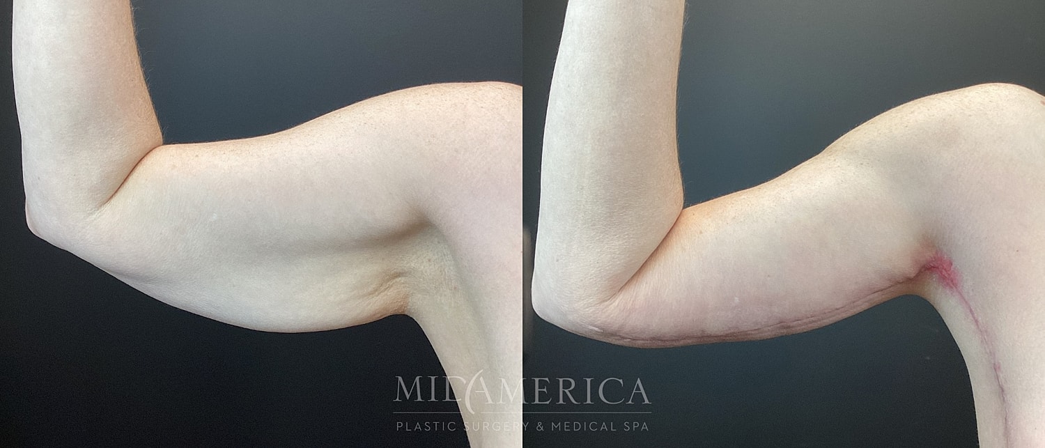 Brachioplasty Before & After