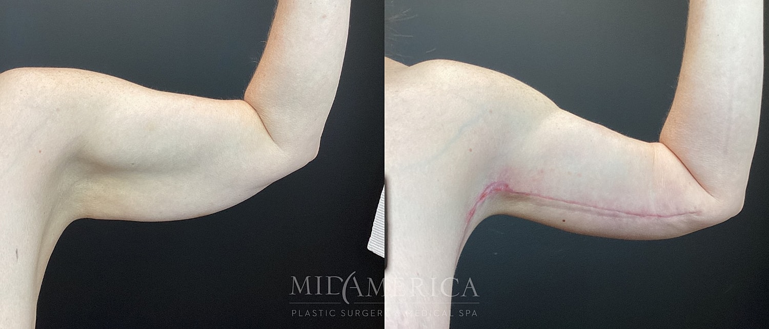Brachioplasty Before & After