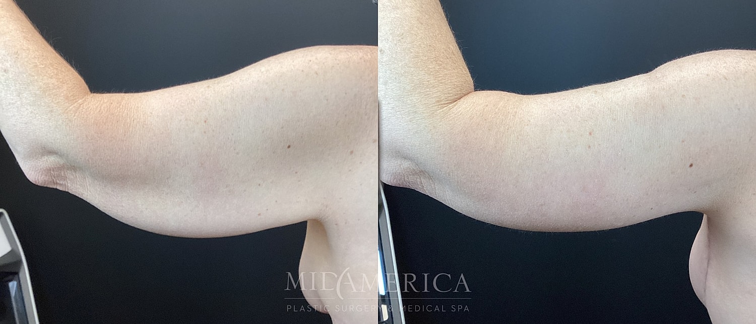 Brachioplasty Before & After