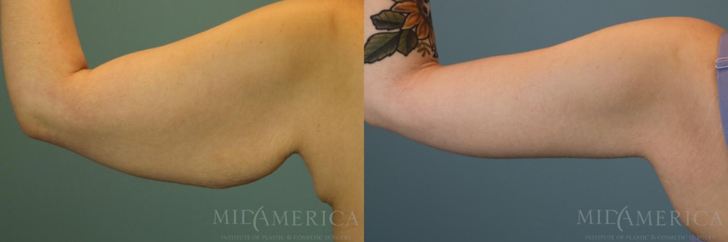 Brachioplasty Before & After