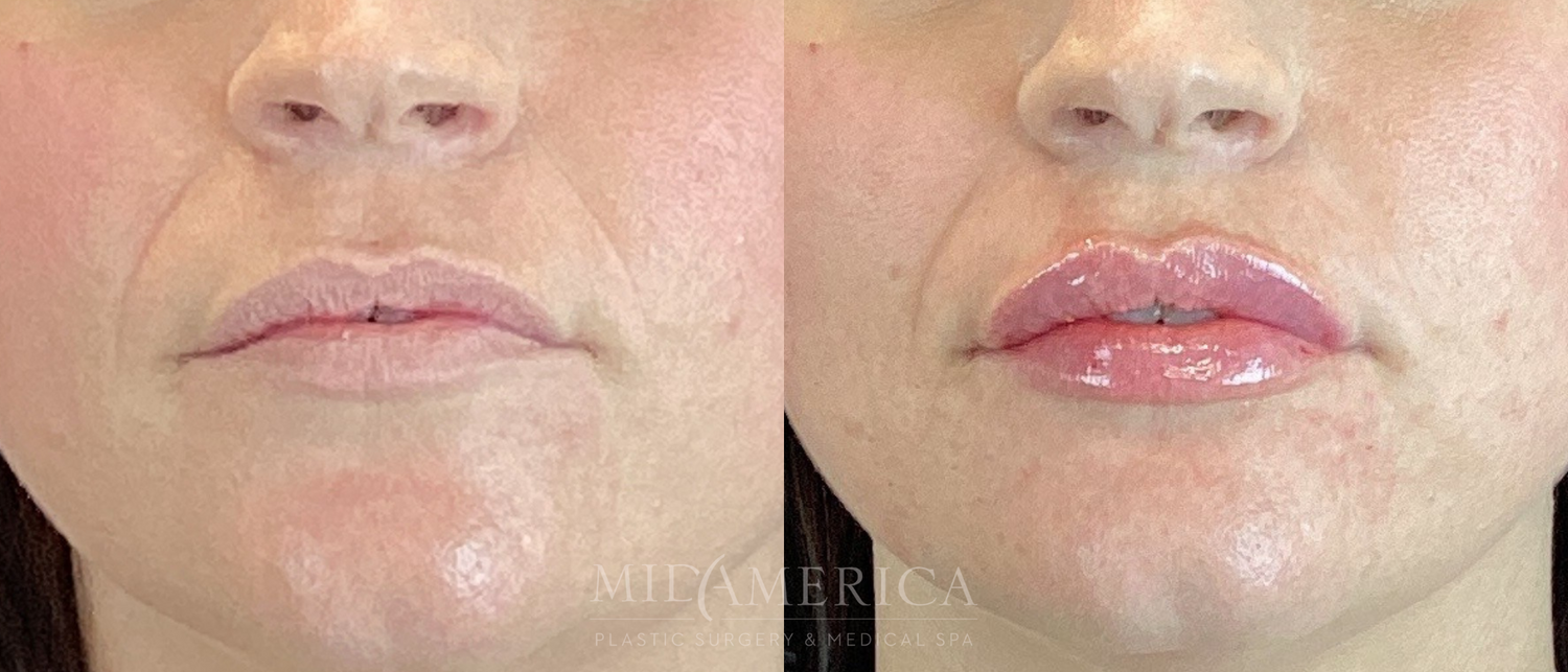 Lip Filler Before & After
