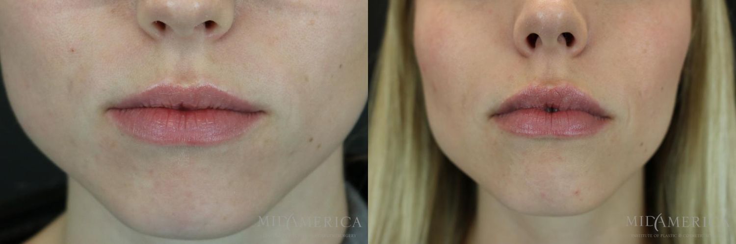 Lip Filler Before & After