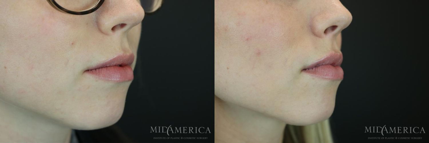 Lip Filler Before & After
