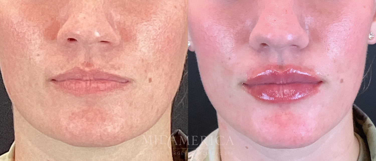 Lip Filler Before & After