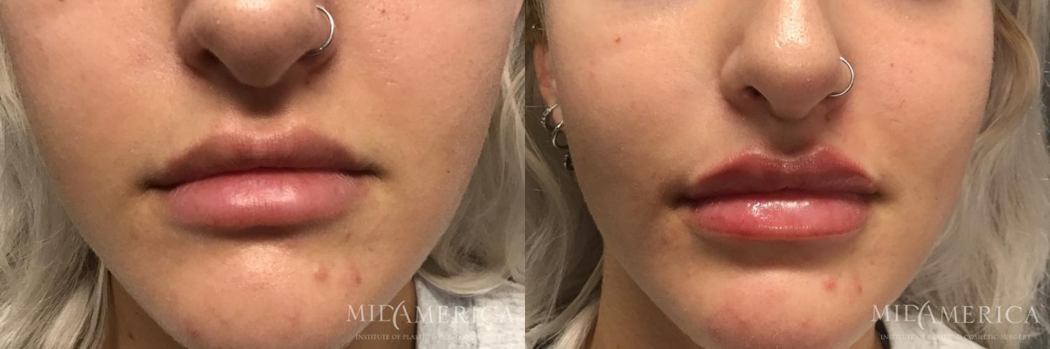 Lip Filler Before & After