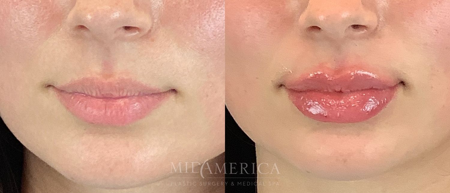 Lip Filler Before & After