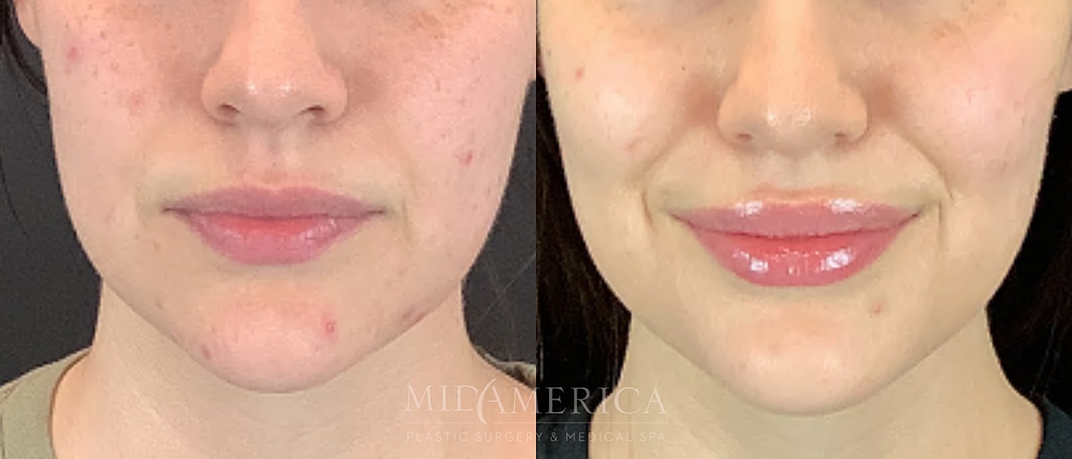 Lip Filler Before & After