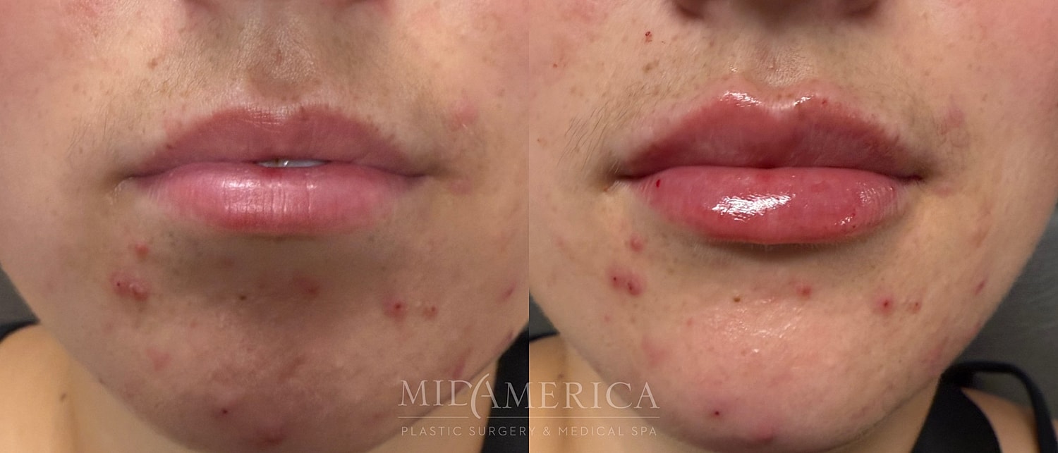 Lip Filler Before & After