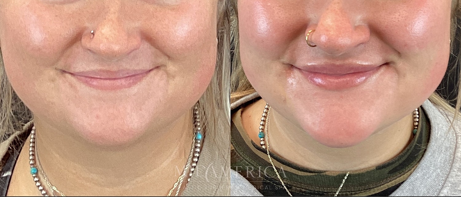 Lip Filler Before & After