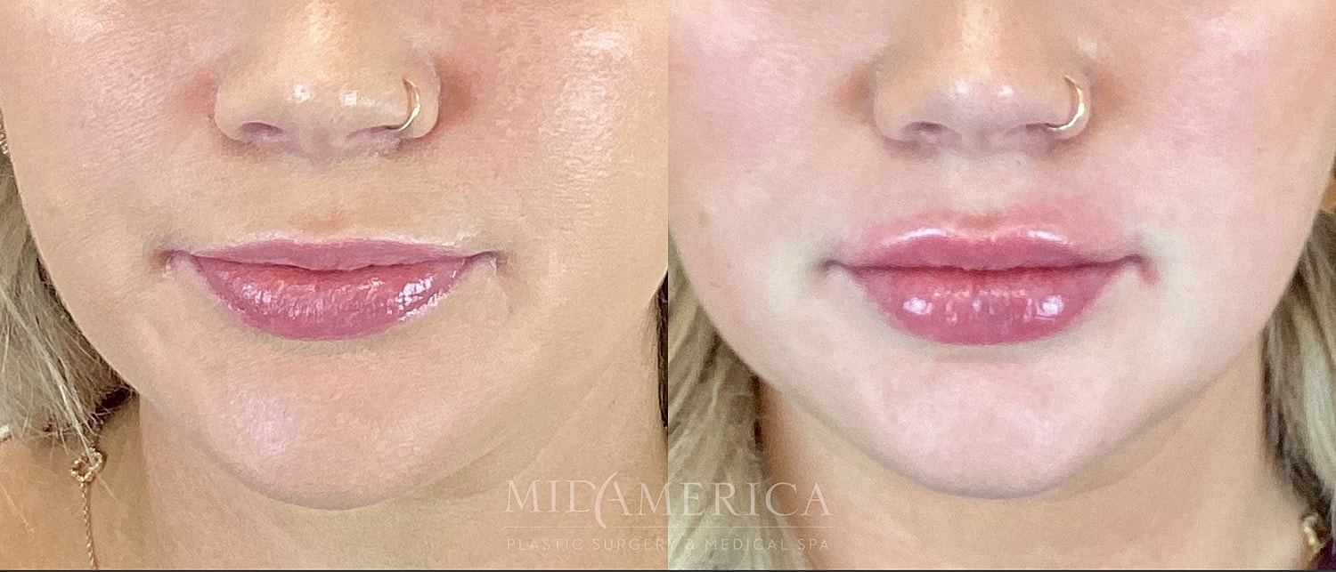 Lip Filler Before & After