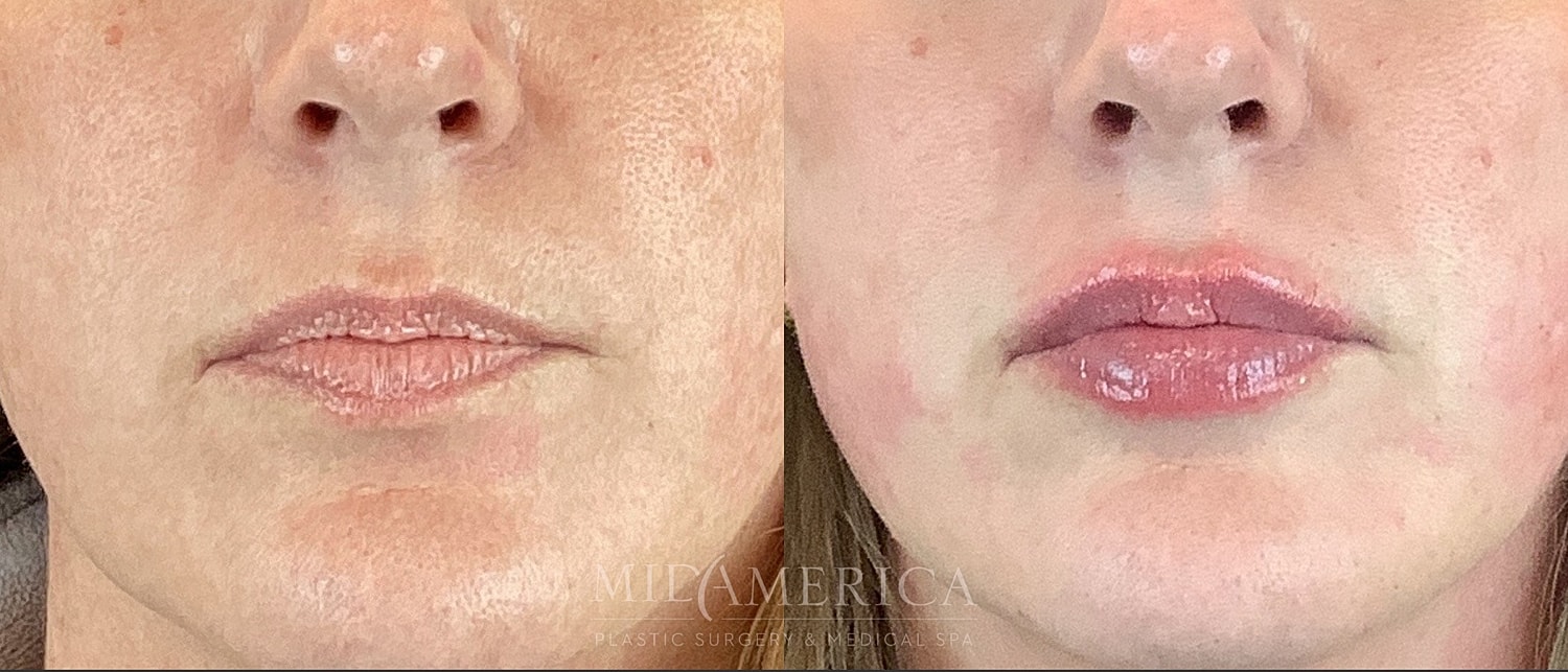 Lip Filler Before & After