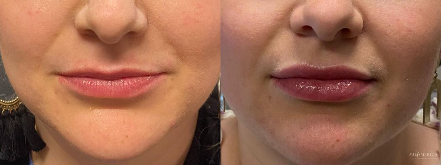 Lip Filler Before & After