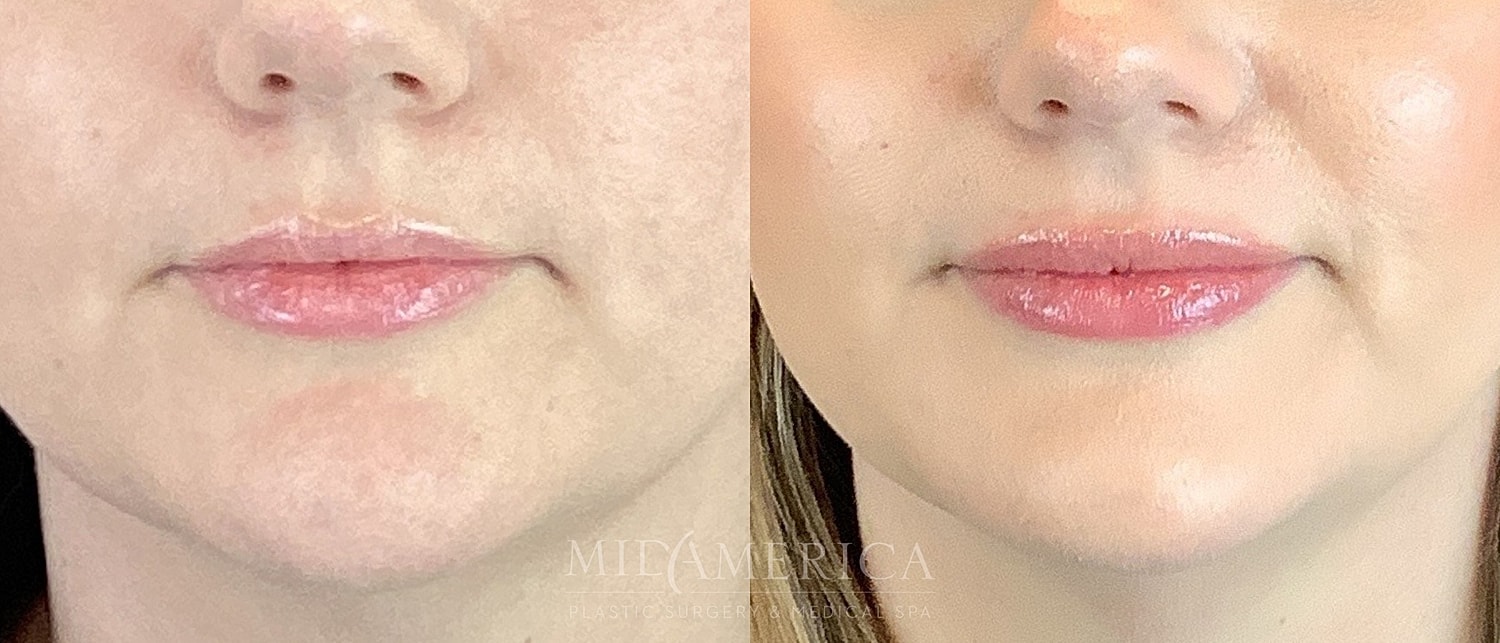 Before and after facial treatment comparison.