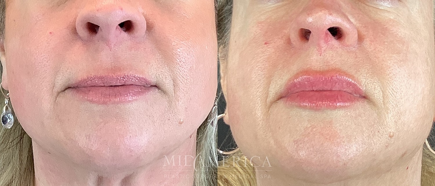Lip Filler Before & After