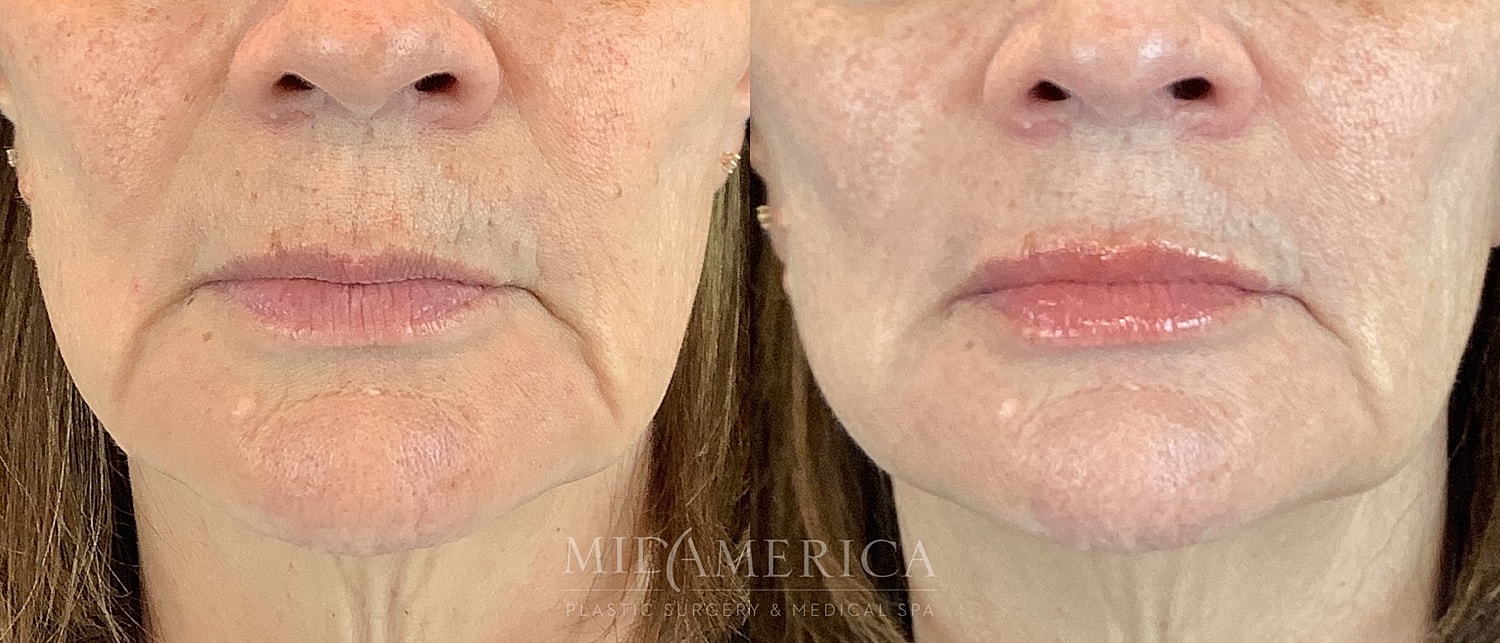 Lip Filler Before & After