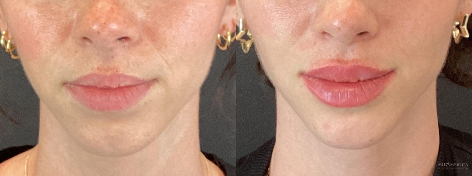 Lip Filler Before & After