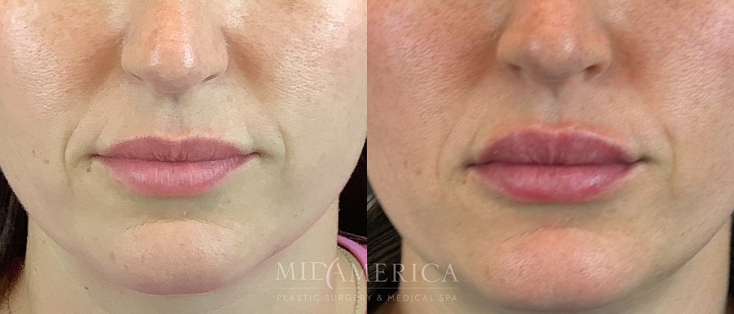 Lip Filler Before & After