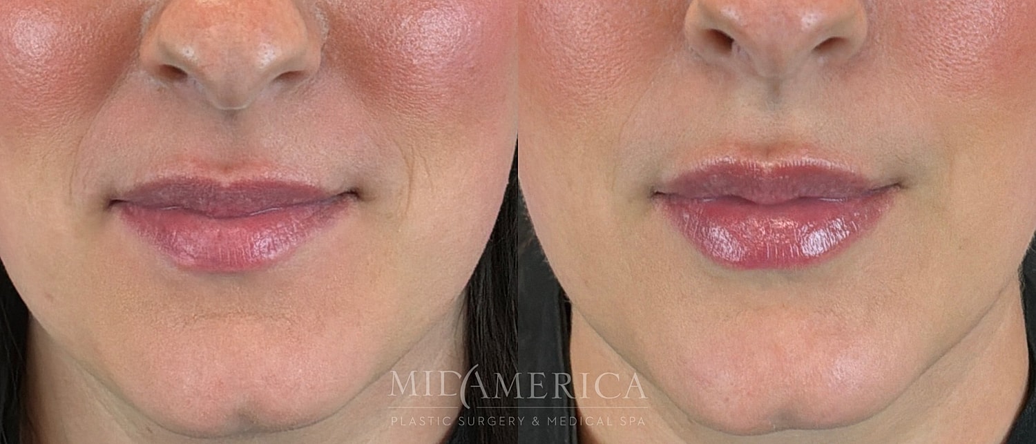 Lip Filler Before & After