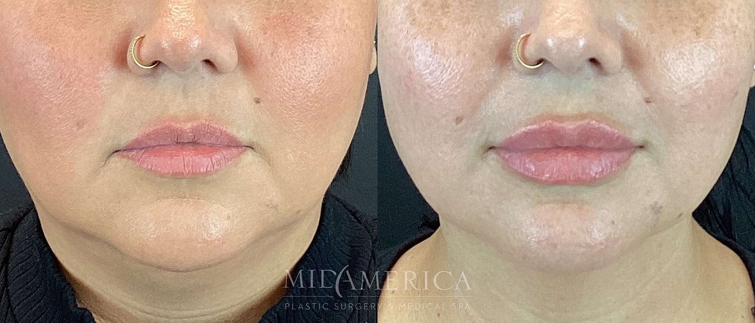 Lip Filler Before & After