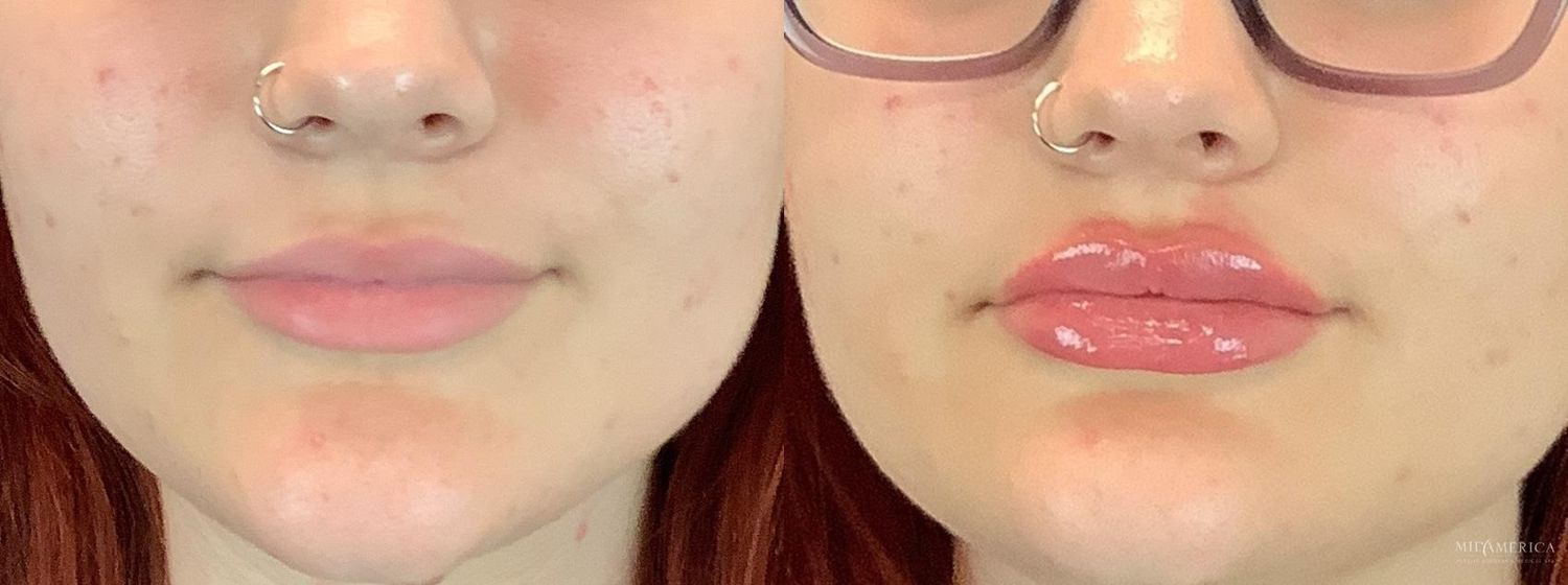 Lip Filler Before & After