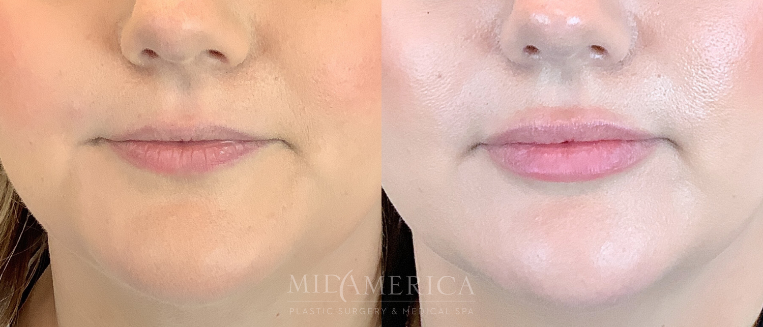 Lip Filler Before & After