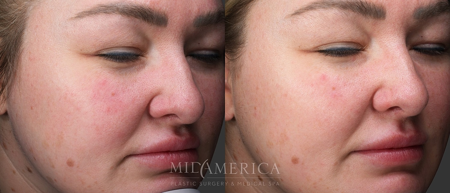 Skin Resurfacing Before & After