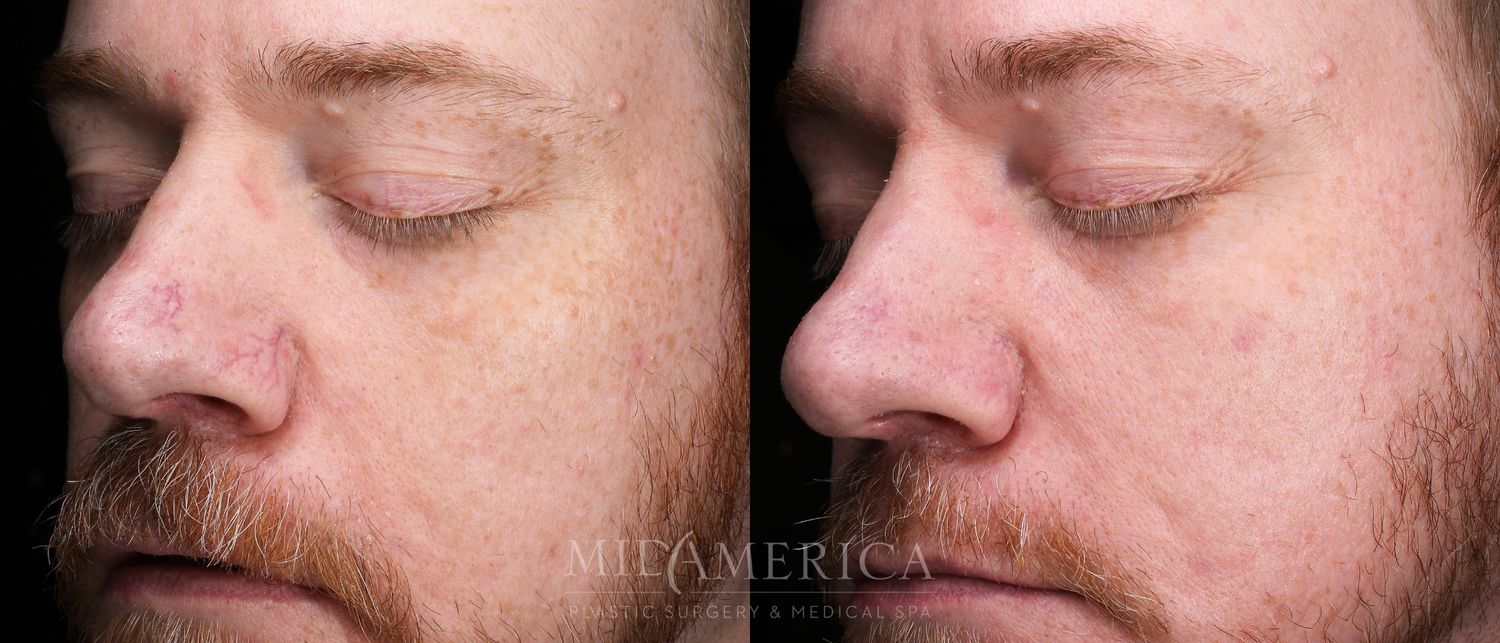 Laser Services Before & After