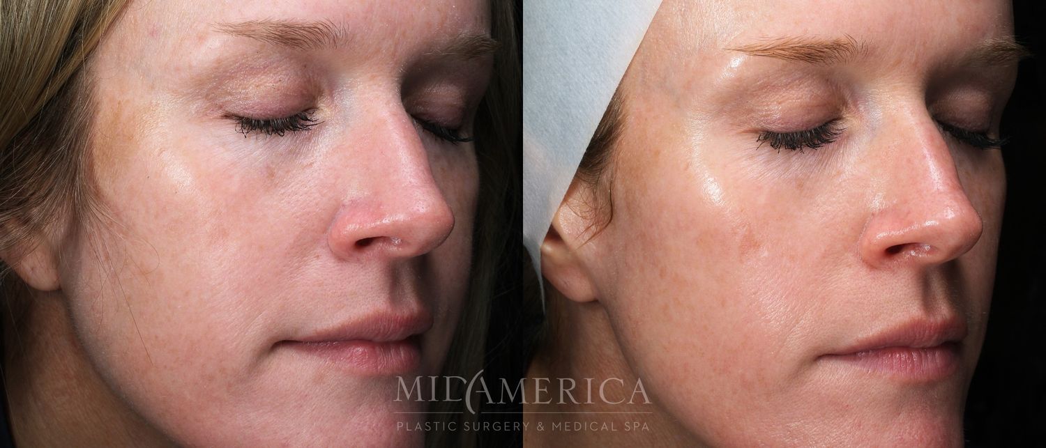 Skin Resurfacing Before & After