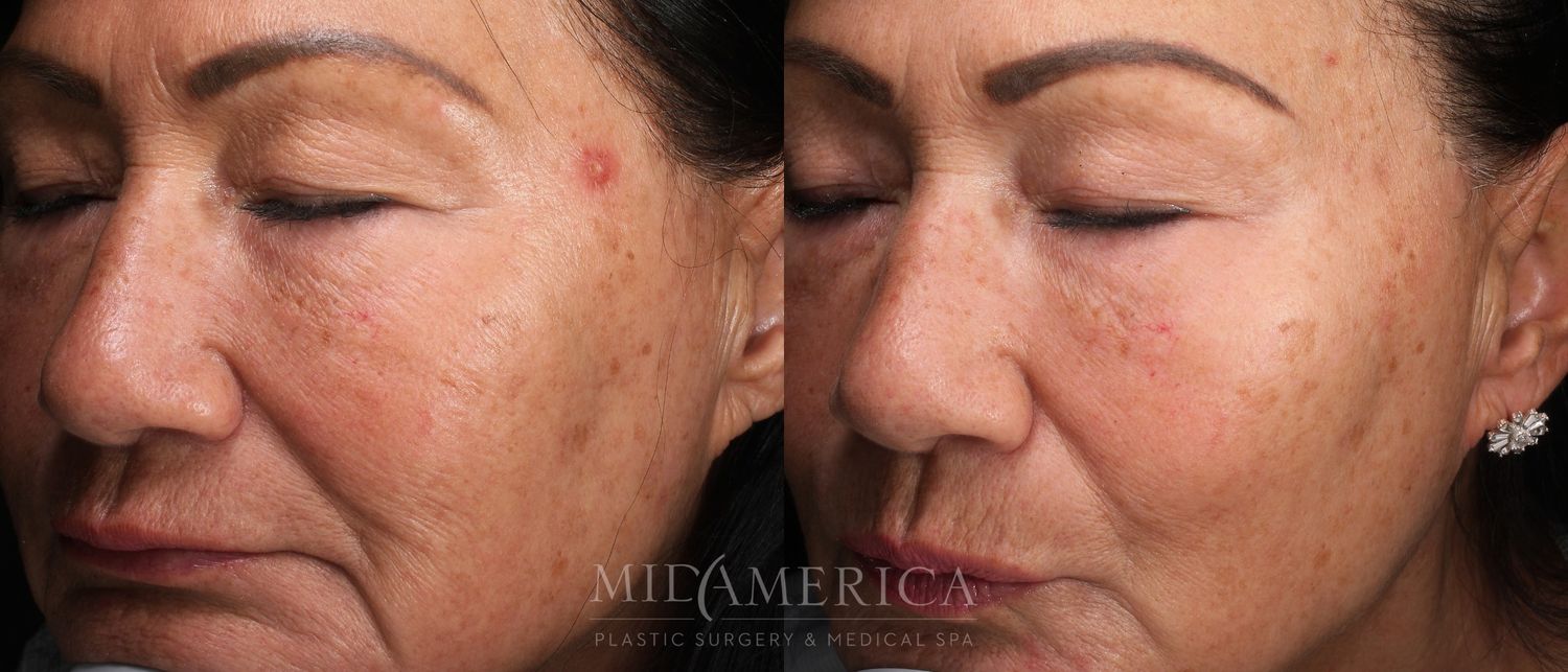 Laser Services Before & After