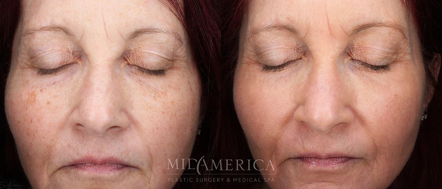 Skin Resurfacing Before & After