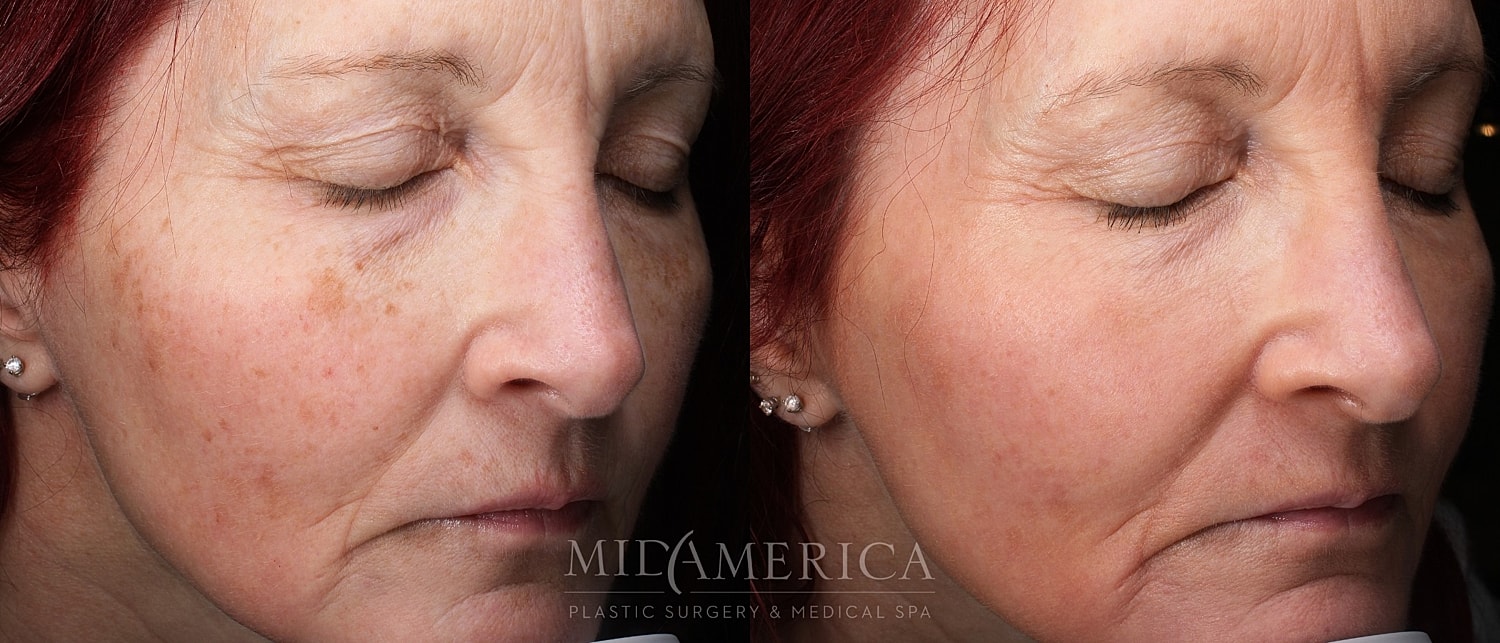 Skin Resurfacing Before & After