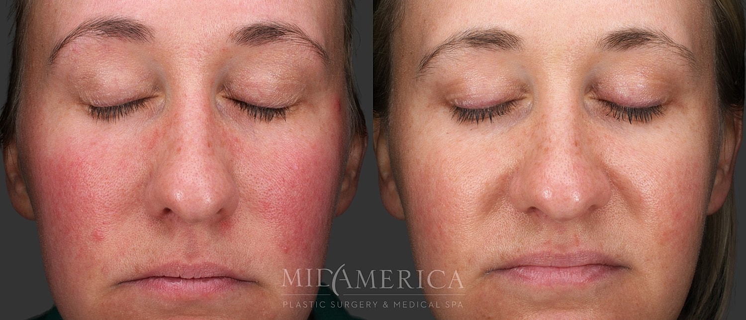 Skin Resurfacing Before & After
