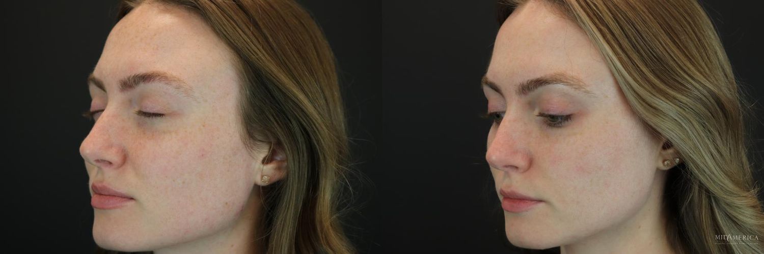 Laser Services Before & After