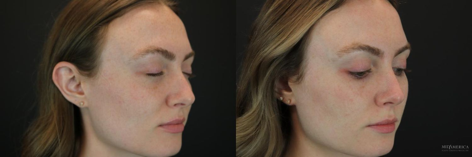 Laser Services Before & After