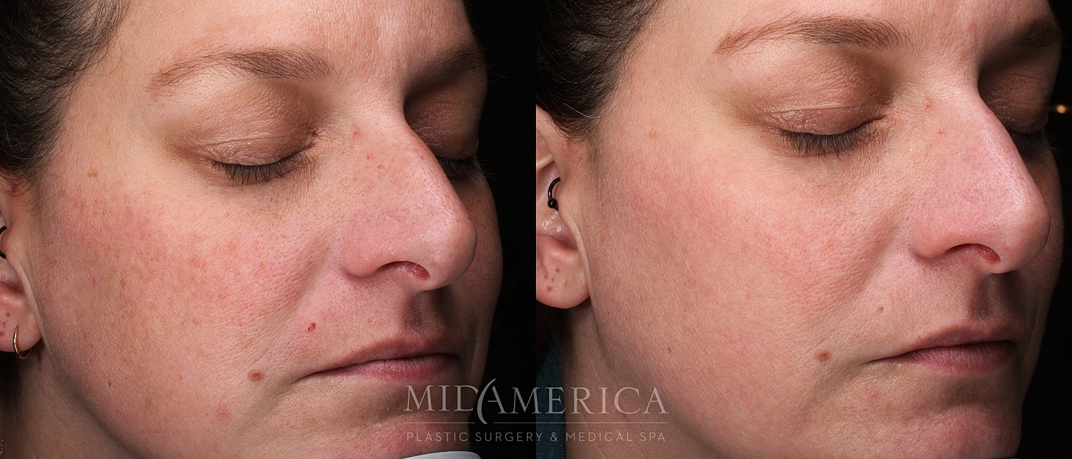 Skin Resurfacing Before & After