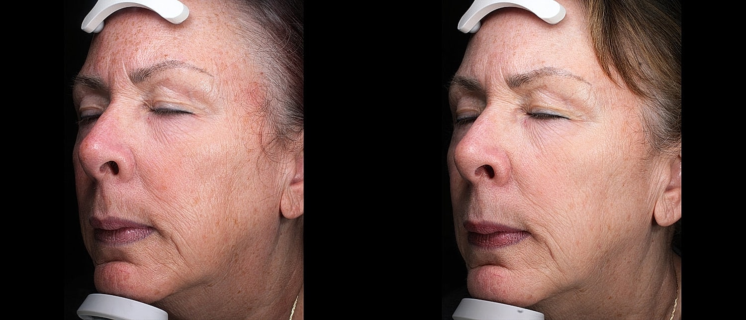 Before and after facial treatment comparison.