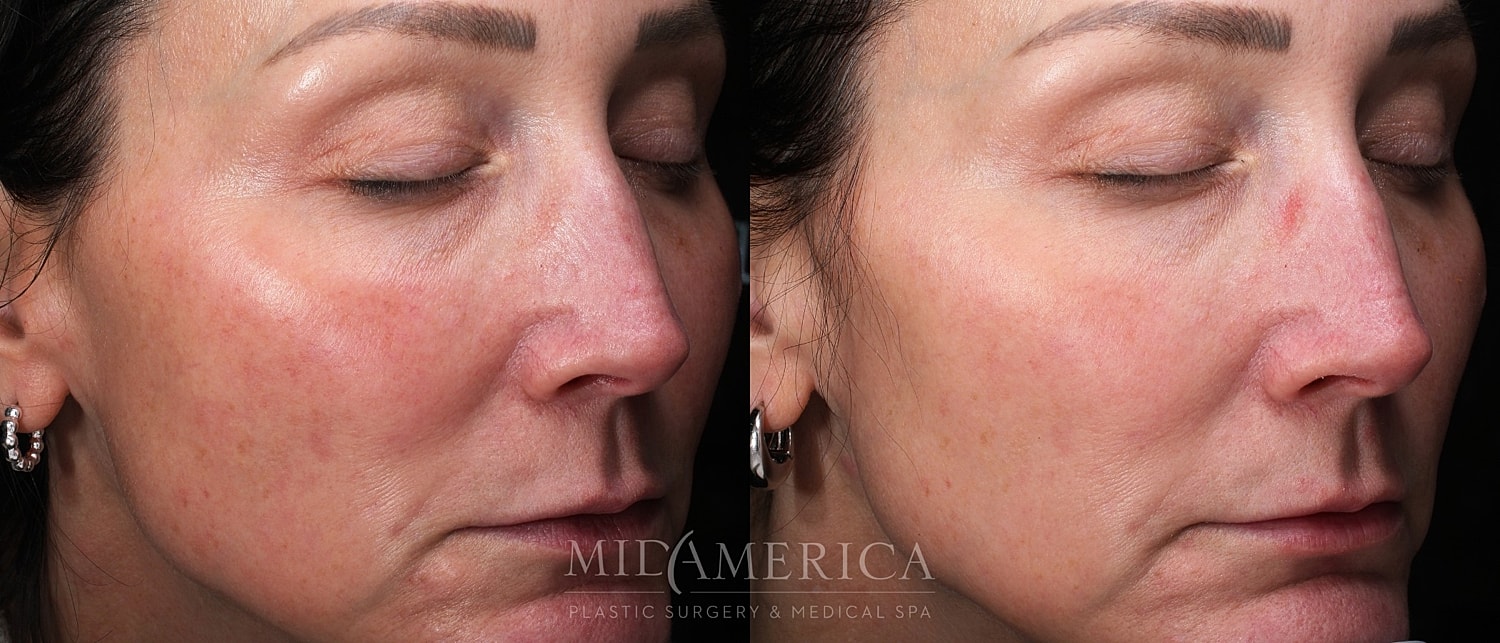 Before and after facial treatment comparison.