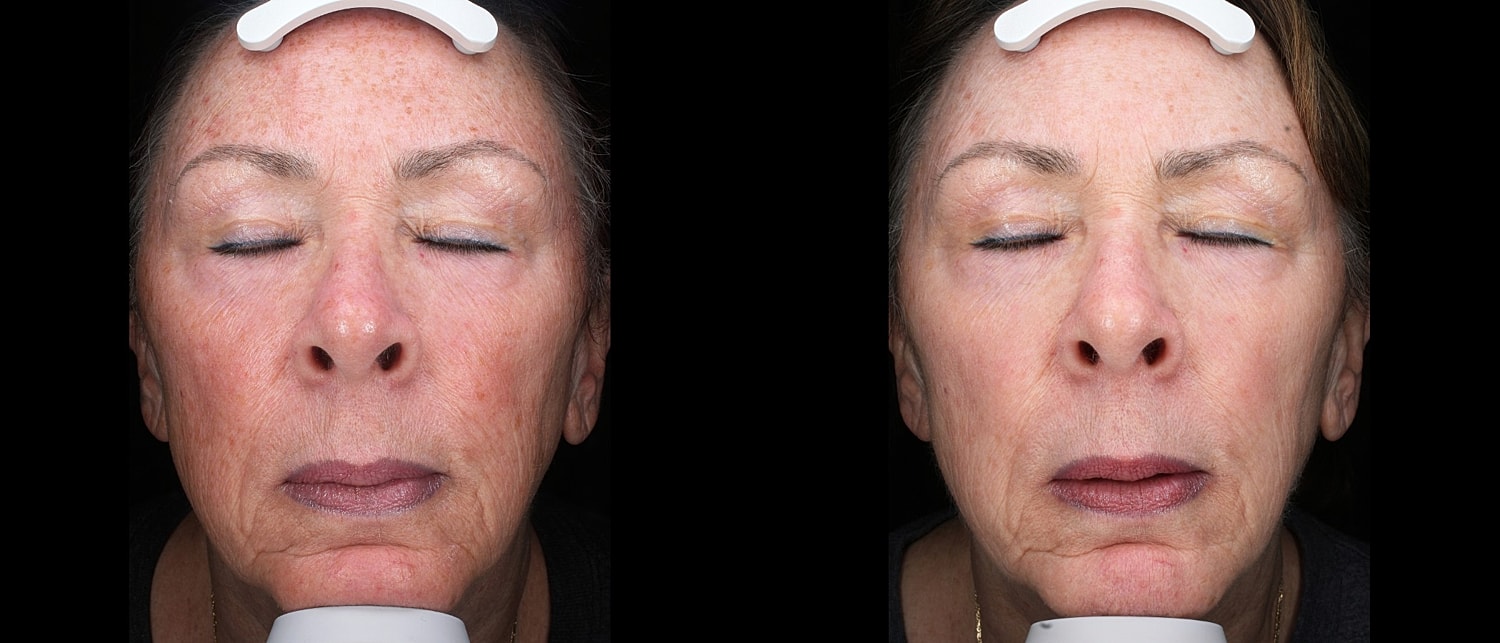 Before and after facial treatment comparison.