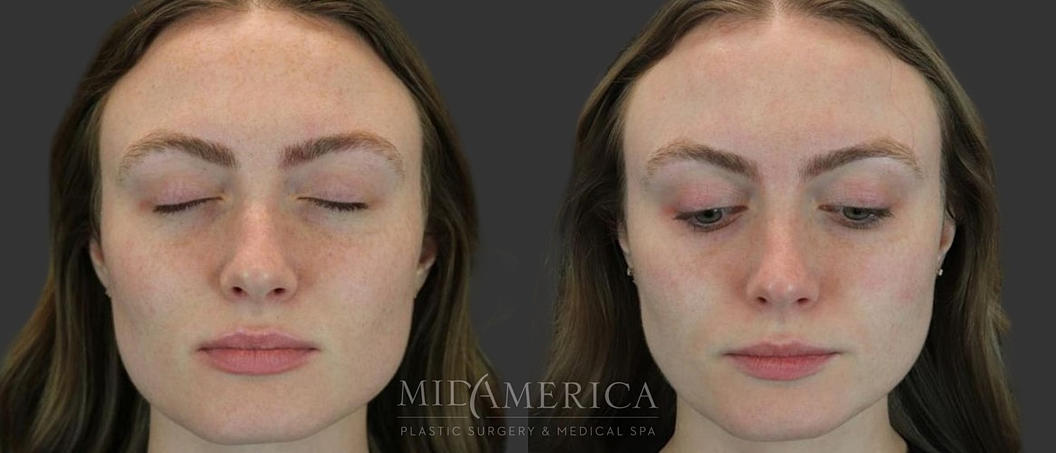 Skin Resurfacing Before & After