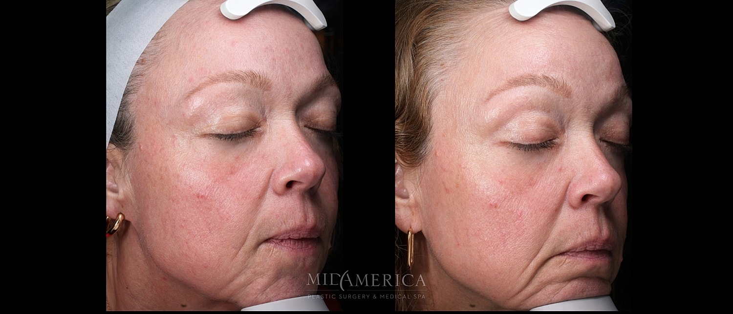 Skin Resurfacing Before & After