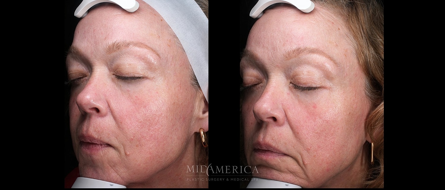 Skin Resurfacing Before & After