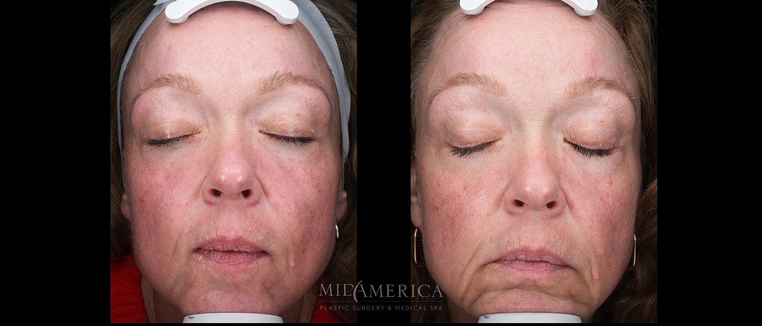 Skin Resurfacing Before & After