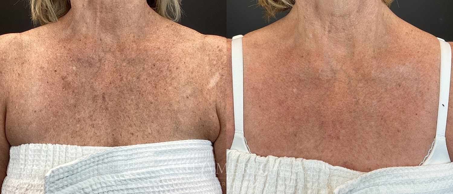 Skin Resurfacing Before & After