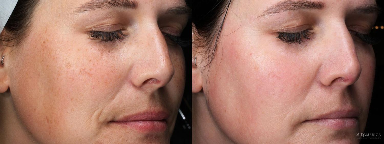 Laser Services Before & After
